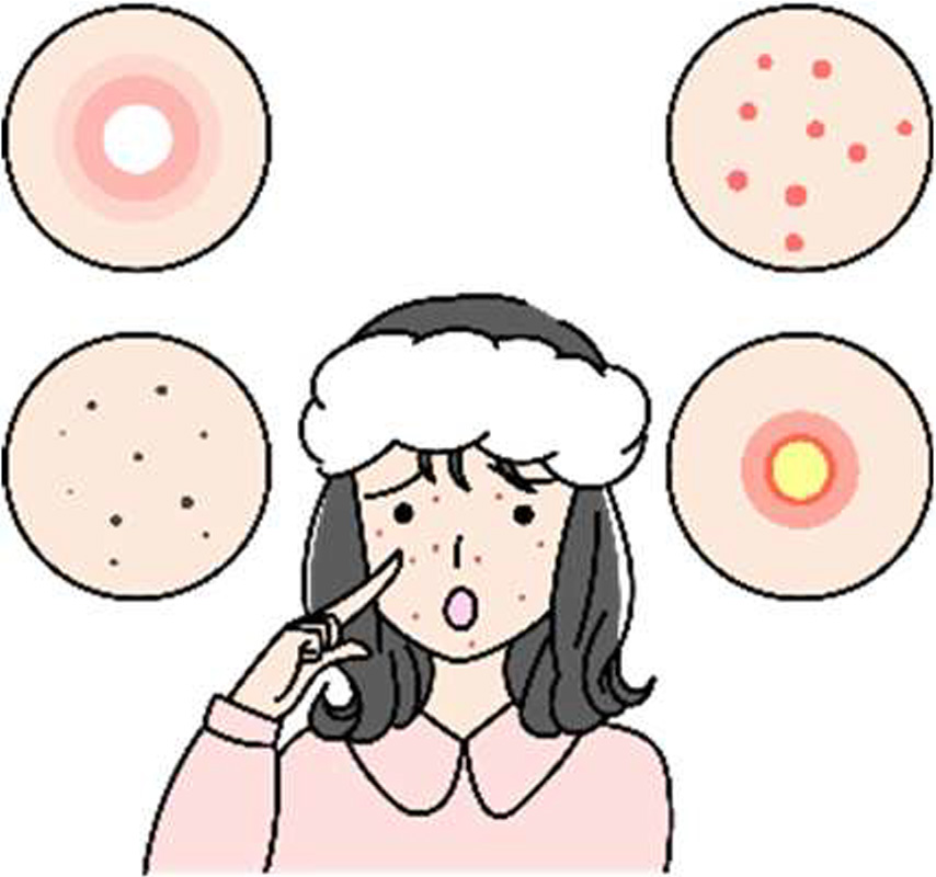 思春期ニキビ