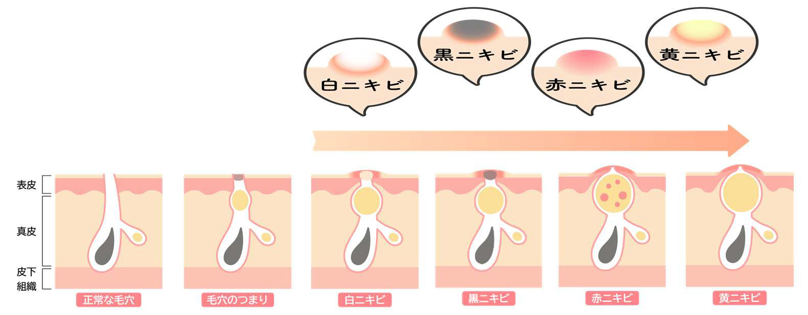 思春期ニキビの経過